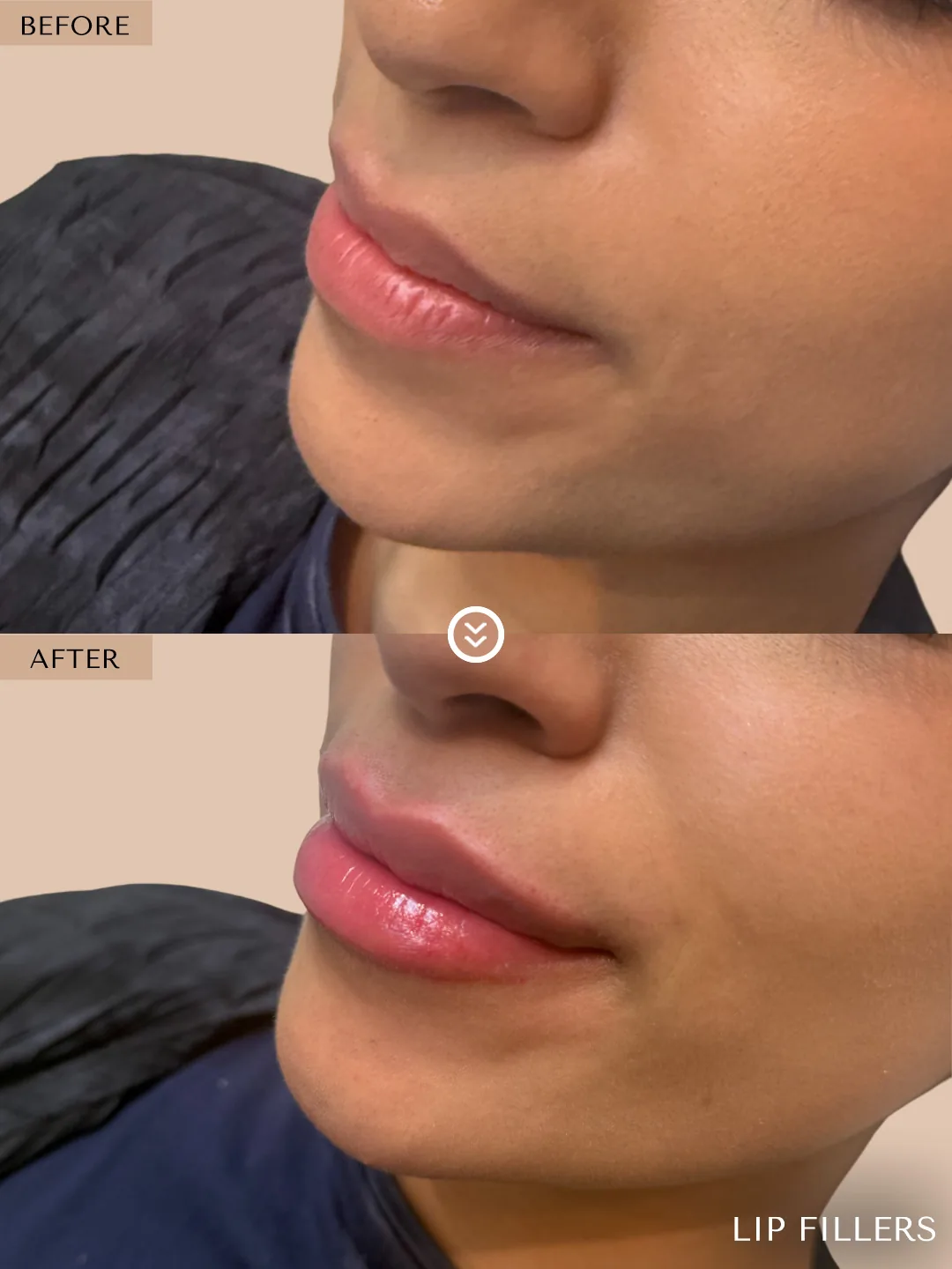 The best work doesn’t announce itself. before and after, case 27, treated by Dr. Nivine Cheaito