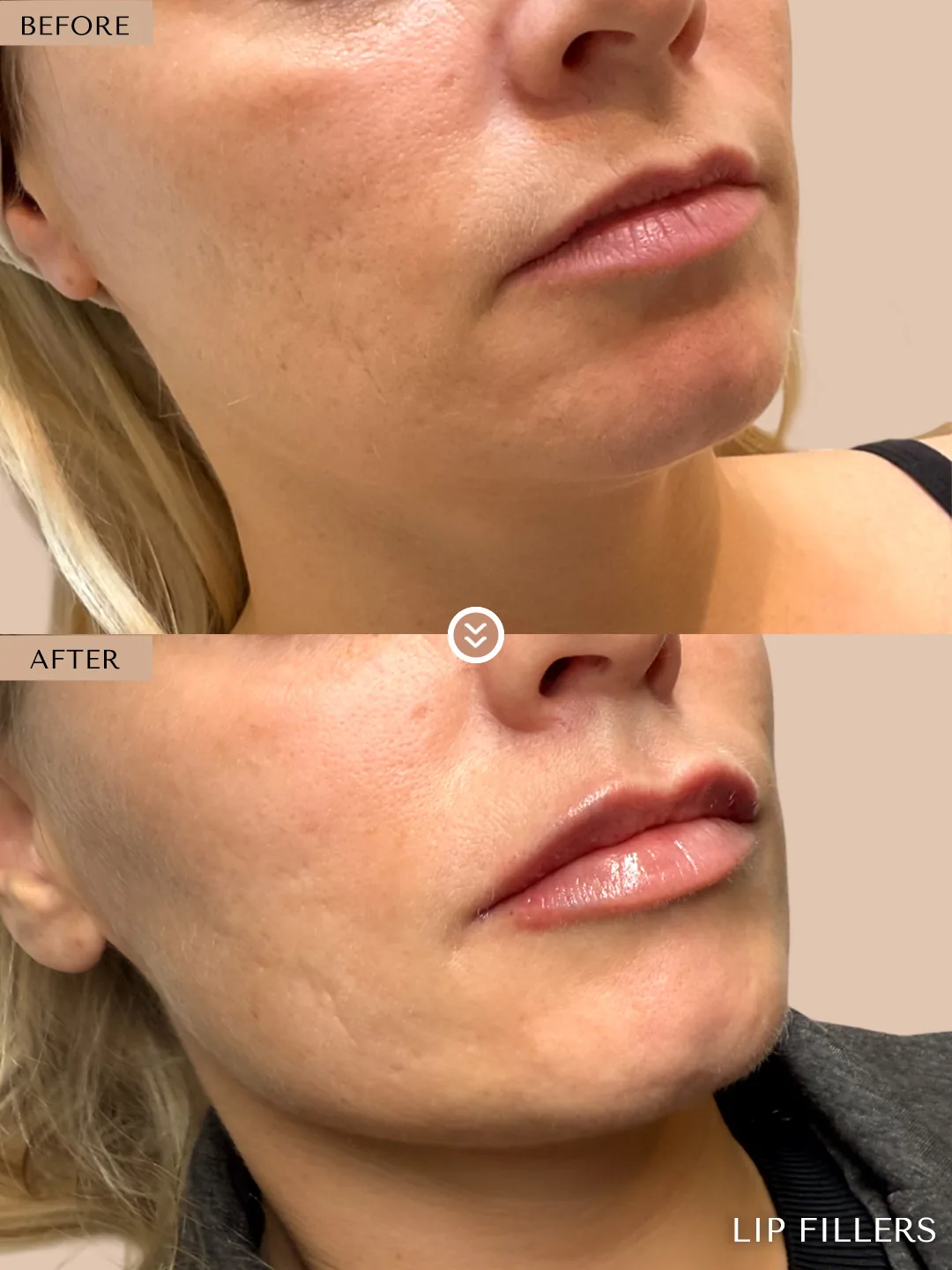 The best work doesn’t announce itself. before and after, case 28, treated by Dr. Nivine Cheaito