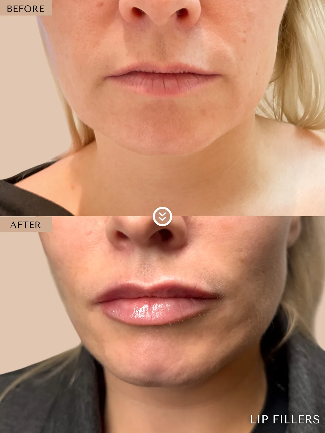 The best work doesn’t announce itself. before and after, case 29, treated by Dr. Nivine Cheaito