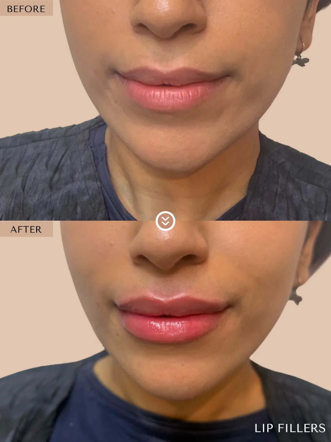 The best work doesn’t announce itself. before and after, case 30, treated by Dr. Nivine Cheaito
