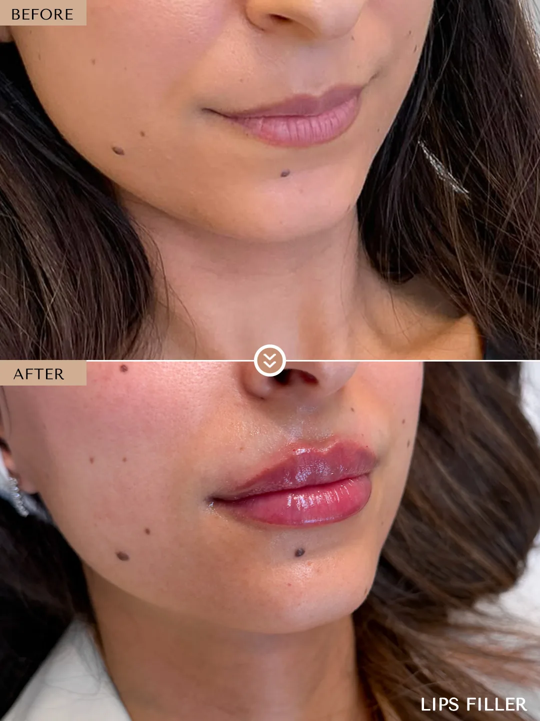 Gummy Smile before and after by Dr. Nivine Cheaito