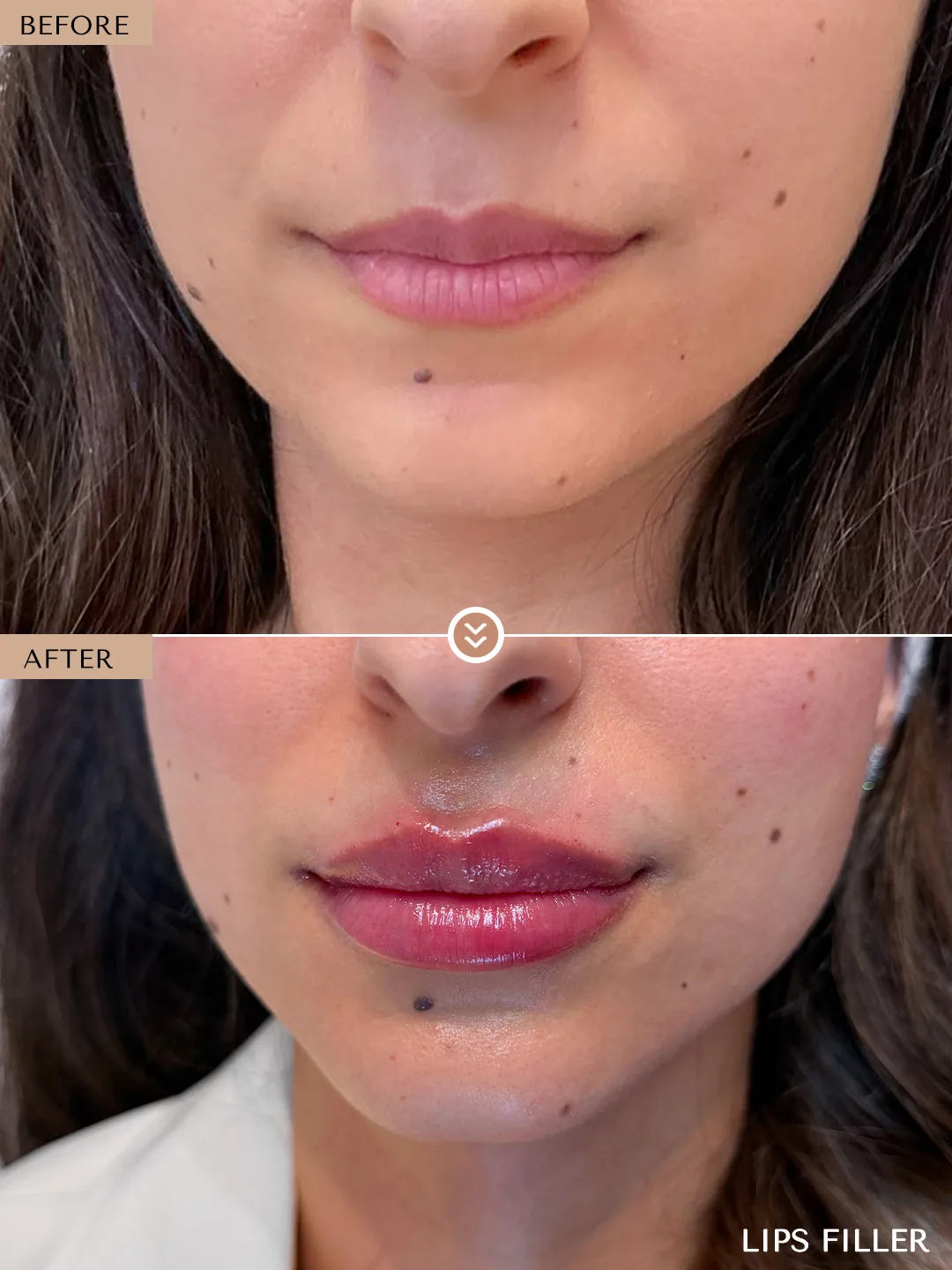 Cupid’s bow definition before and after by Dr. Nivine Cheaito