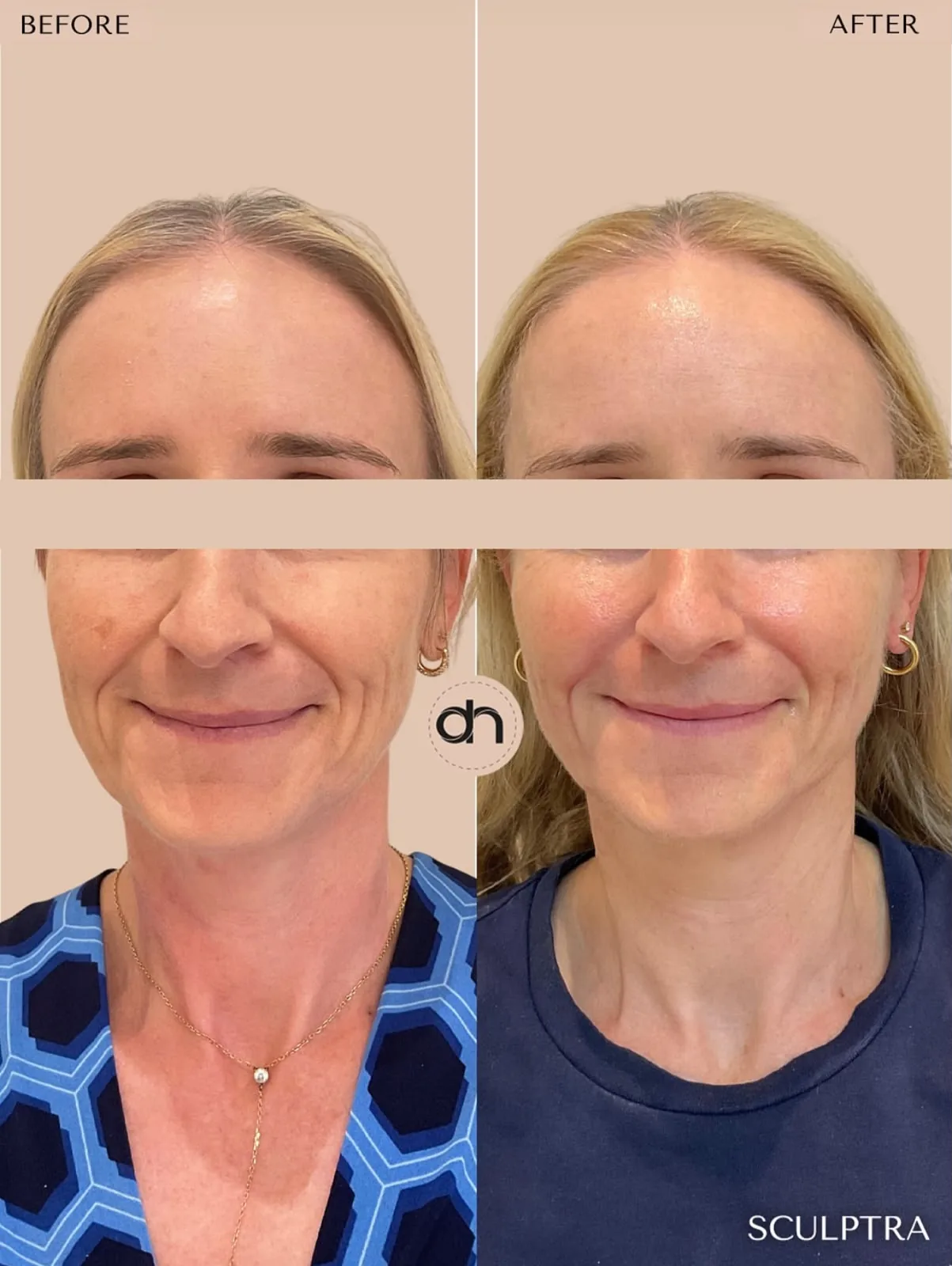 Collagen Stimulation before and after by Dr. Nivine Cheaito