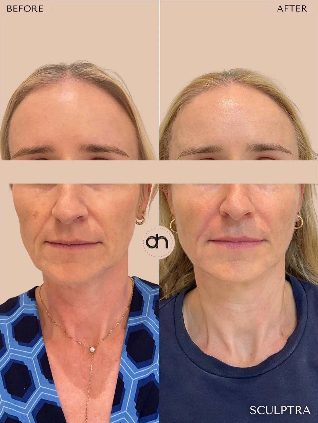 Collagen Stimulation before and after by Dr. Nivine Cheaito