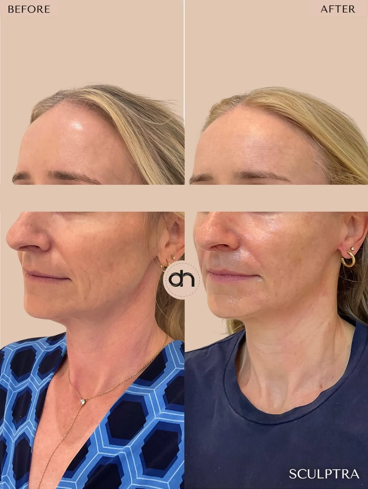 Collagen Stimulation before and after by Dr. Nivine Cheaito