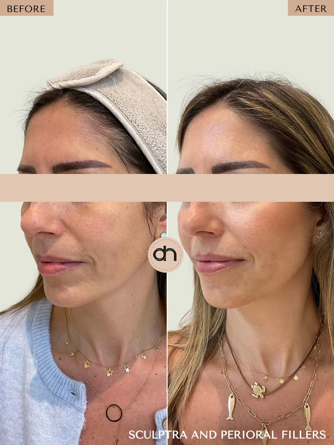 Collagen Stimulation before and after by Dr. Nivine Cheaito