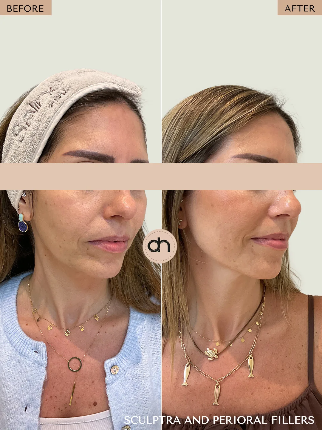 Collagen Stimulation before and after by Dr. Nivine Cheaito