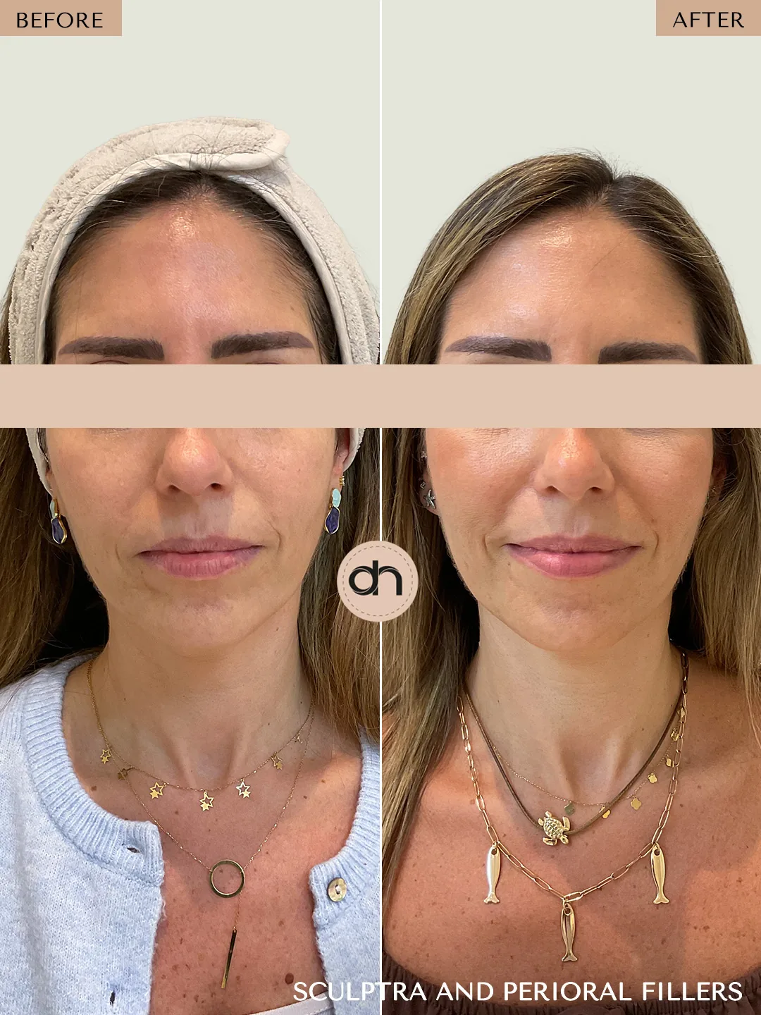 Collagen Stimulation before and after by Dr. Nivine Cheaito