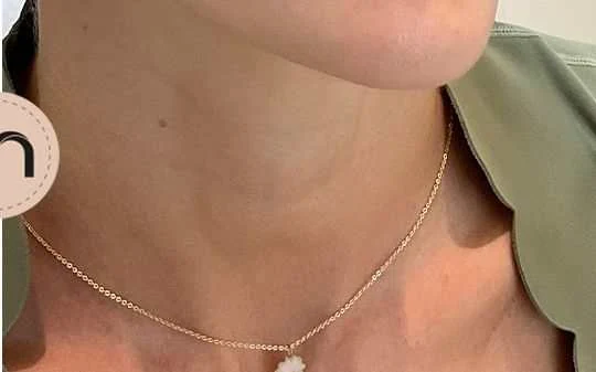 Neck and décolleté before and after by Dr. Nivine Cheaito