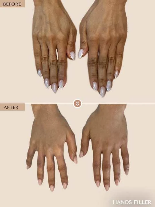 Hand Rejuvenation before and after by Dr. Nivine Cheaito