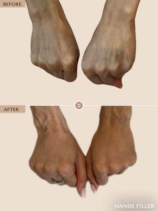 Hand Rejuvenation before and after by Dr. Nivine Cheaito