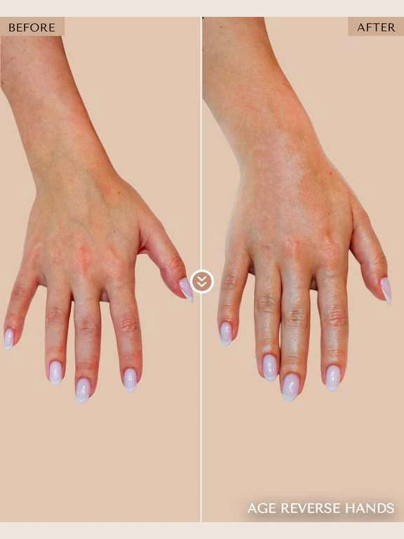 Hand Rejuvenation before and after by Dr. Nivine Cheaito