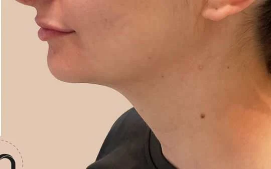 Hydration and elasticity before and after by Dr. Nivine Cheaito
