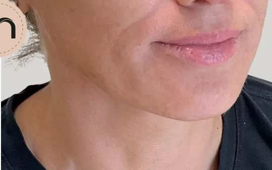 Texture and tone before and after by Dr. Nivine Cheaito